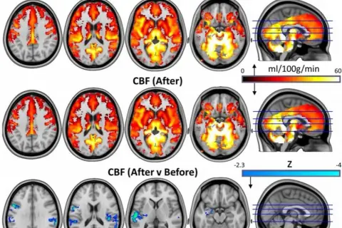 Psylocybina na depresję: Czy "resetuje" mózg? Badania i prawo